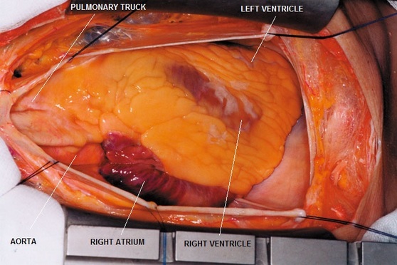 Exposure of Coronary Arteries - CThSurgery.com